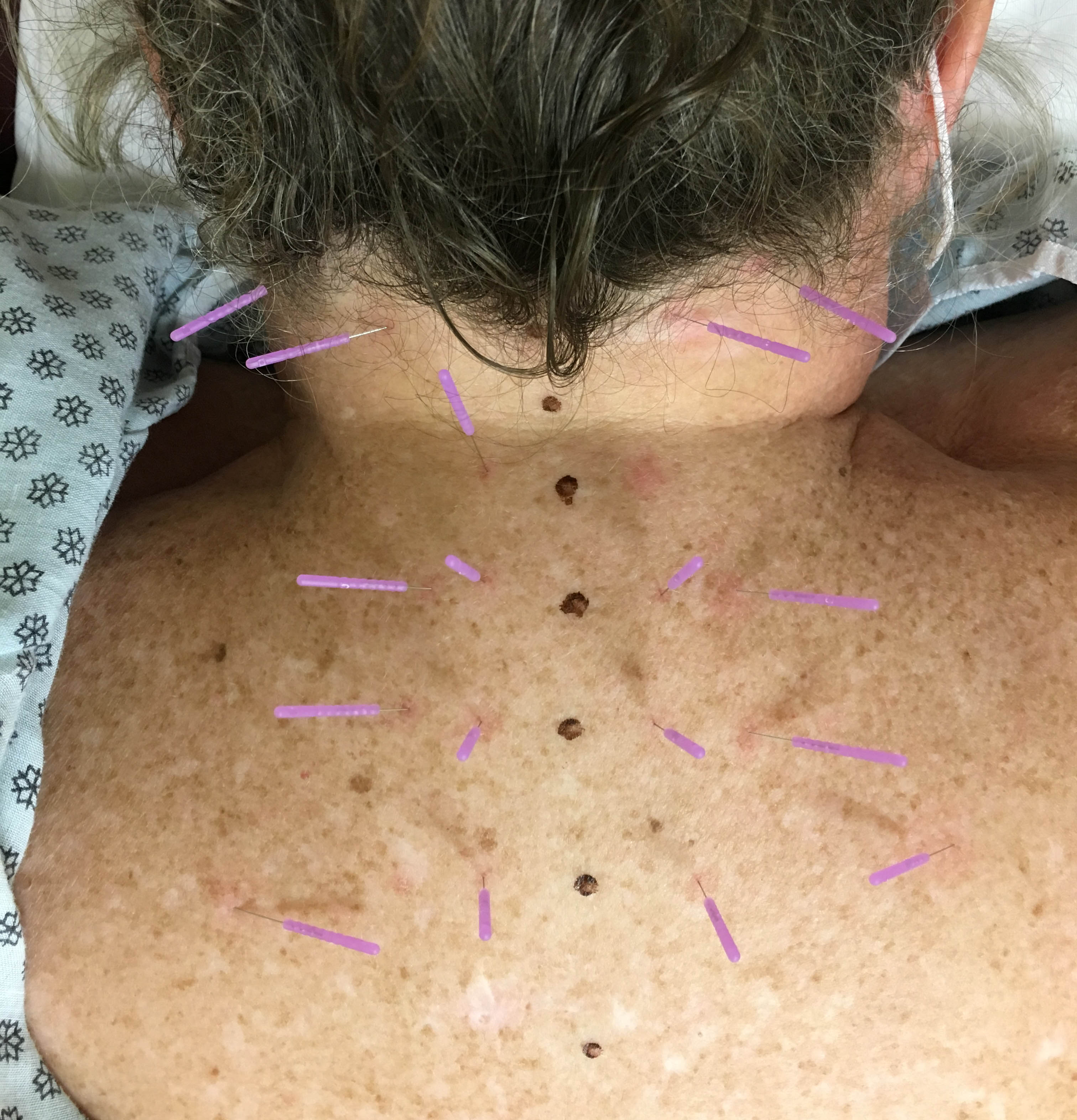 Woman Undergoing Dry Needling Woman Undergoing Dry Needling