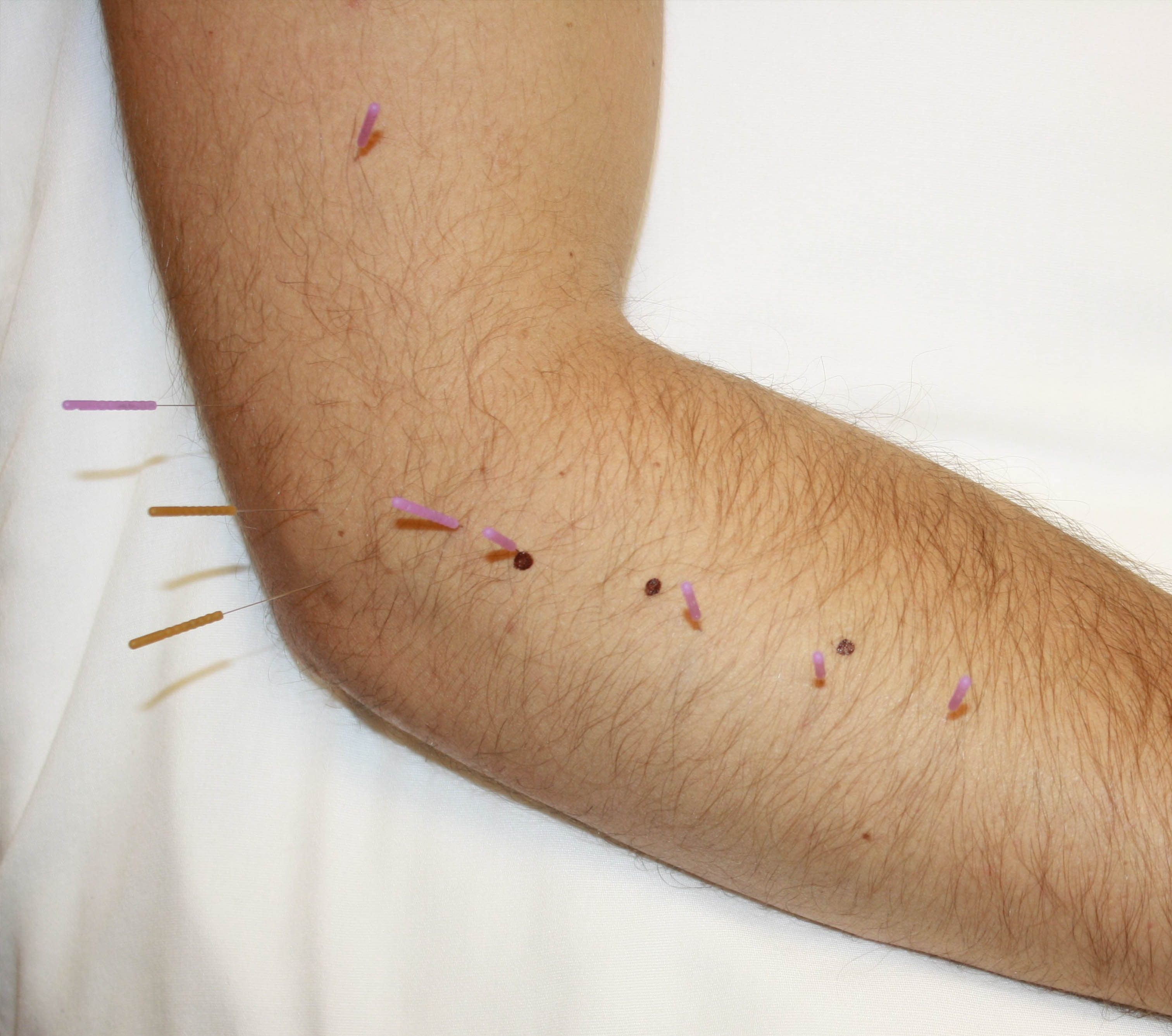 Arm With Needles Arm With Needles